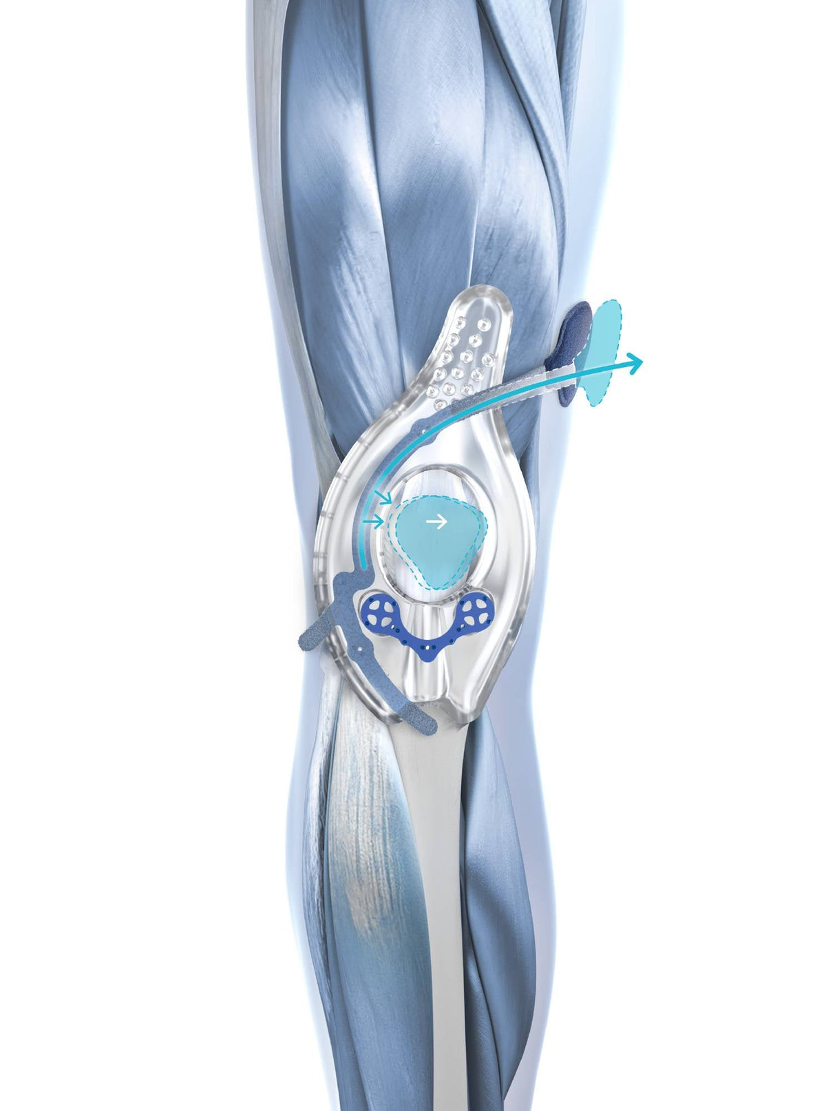 GenuTrain P3 corrective strap and pad on the knee anatomy